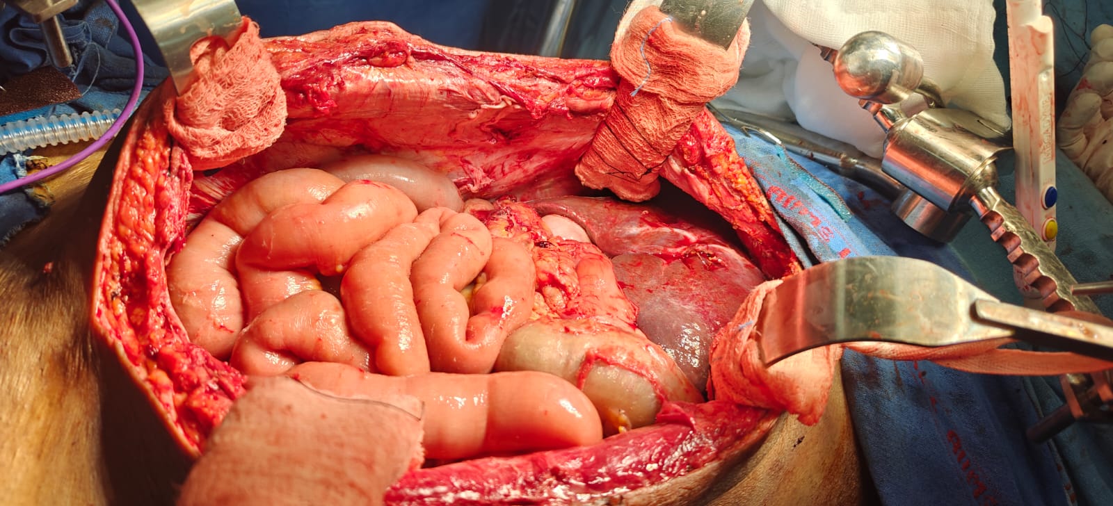 CRS Surgery in Delhi, India, AIIMS, by Prof. Dr. M.D. Ray