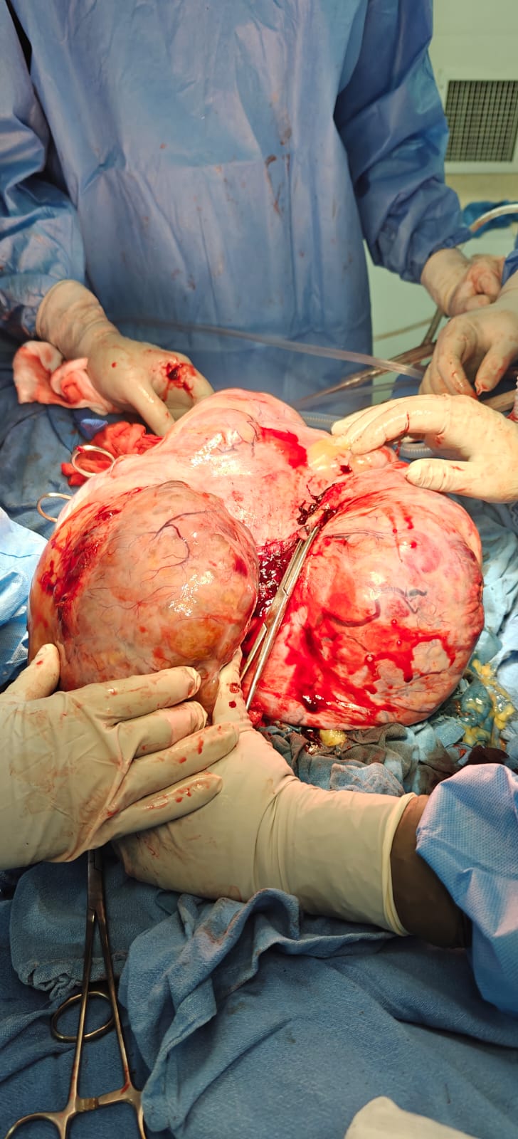 Cytoreductive Surgery Delhi