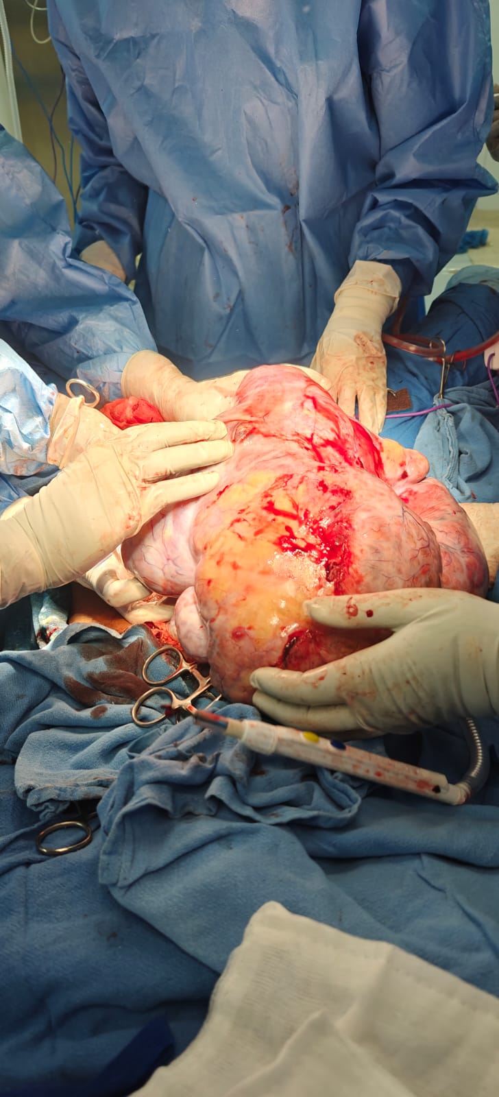 Cytoreductive Surgery Aiims