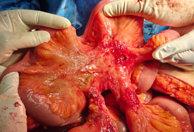 Peritonectomy Surgery